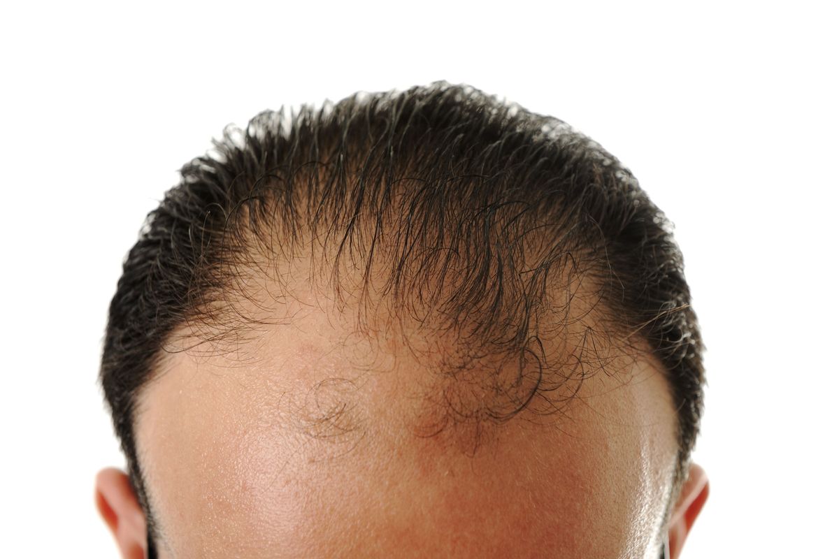 Your Diabolical Follicles: Treating Male Pattern Baldness ...