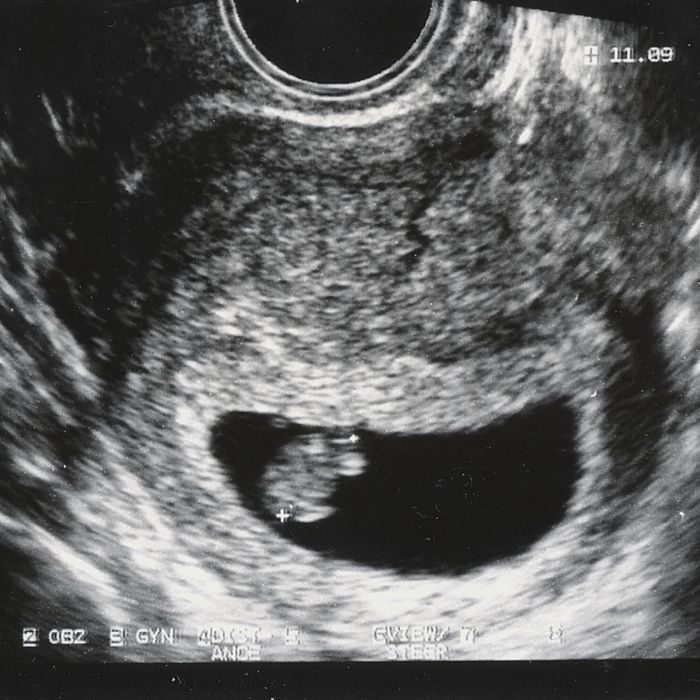 23-ultrasound.w700.h700.jpg